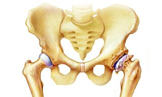 почему возникает остеоартроз тазобедренного сустава